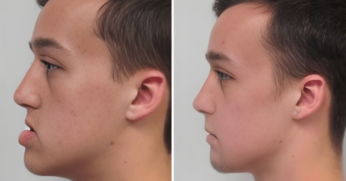 Future of Jaw Reconstruction 3D Printing & AI