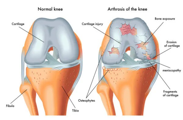 Arthritis Reconstruction in Mumbai