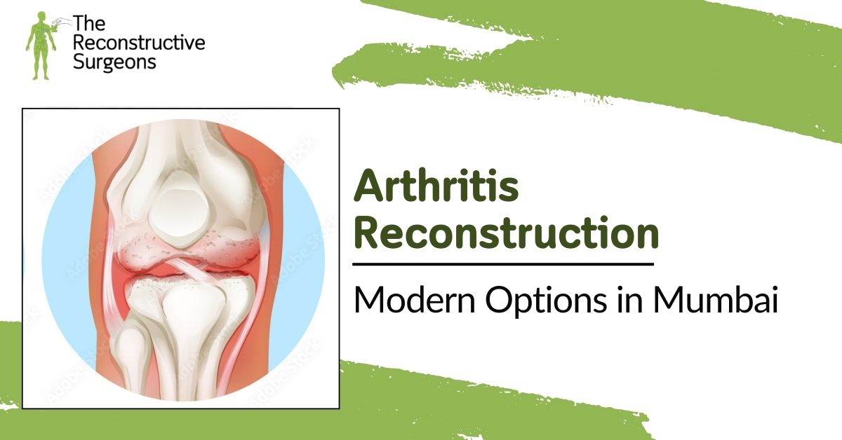 Arthritis Reconstruction in Mumbai