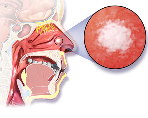 nasal reconstruction after cancer in Mumbai