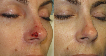 nasal reconstruction after cancer