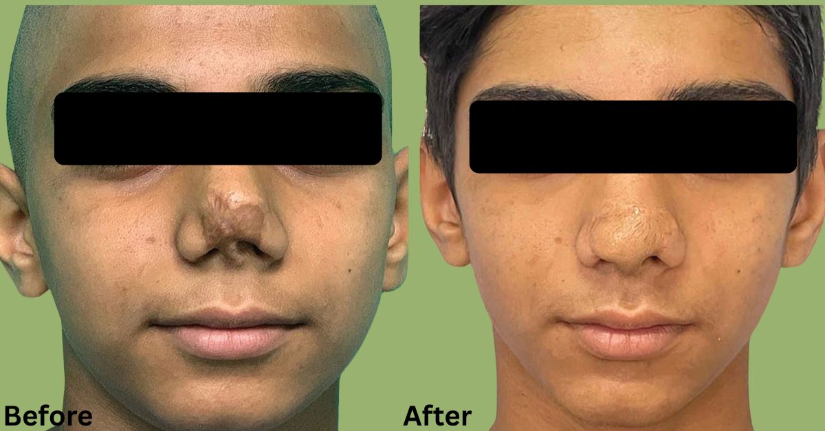 Nasal Reconstruction After Trauma or Cancer In mumbai by Dr. Vinay Jacob
