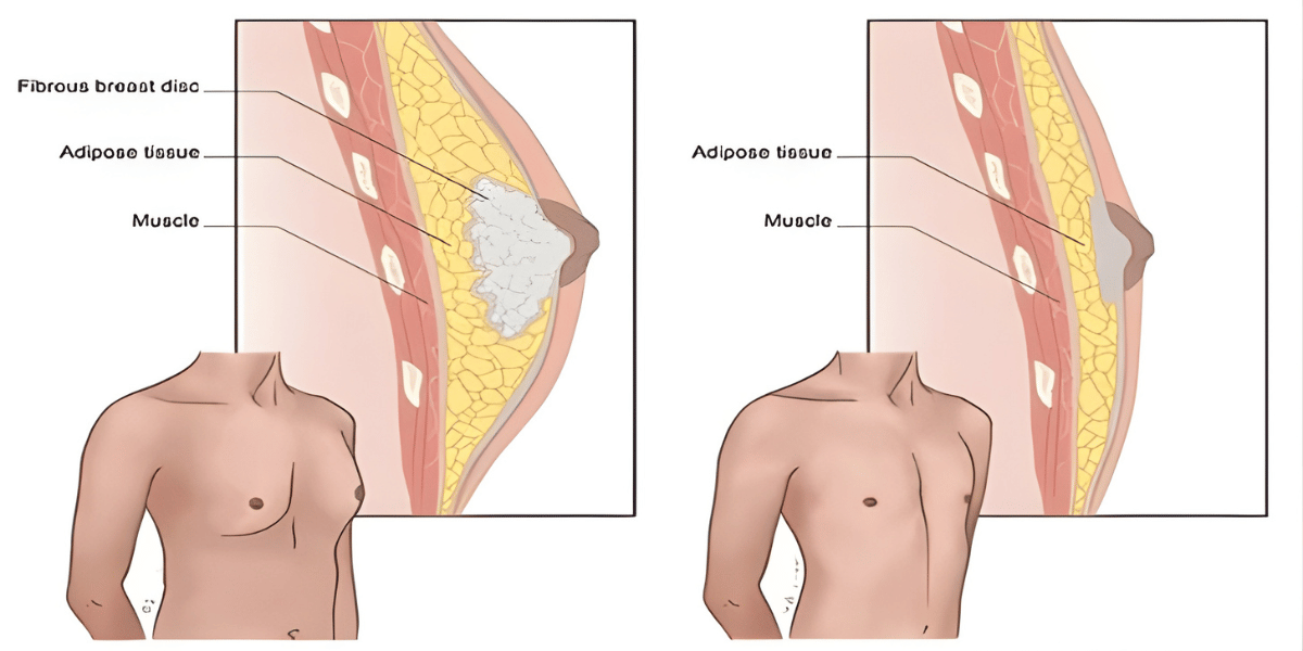 Non-Surgical Gynecomastia Treatment Options
