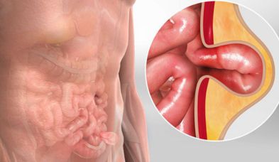 Hernia Surgery in Mumbai by Dr. Vinay Jacob at the Reconstructive Surgeons