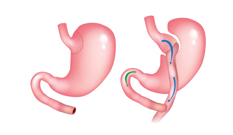 Bariatric Surgery in Mumbai by Dr. Vinay Jacob at the Reconstructive Surgeons