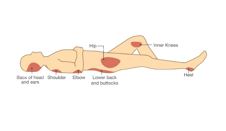 Pressure Sore or Bed Sore Surgery in Mumbai by Dr. Vinay Jacob at the Reconstructive Surgeons