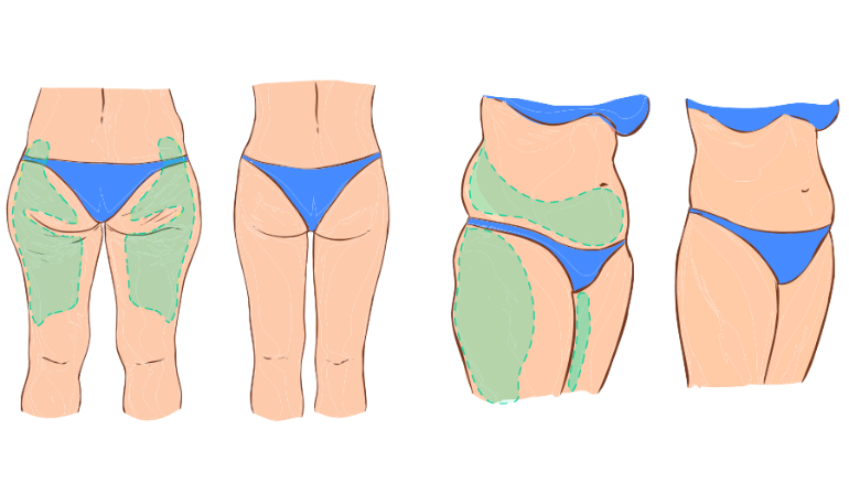Body Lift Contour Surgery in Mumbai by Dr. Vinay Jacob at the Reconstructive Surgeons