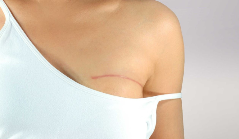 Breast Reconstruction after Mastectomy in Mumbai by Dr. Vinay Jacob at the Reconstructive Surgeons