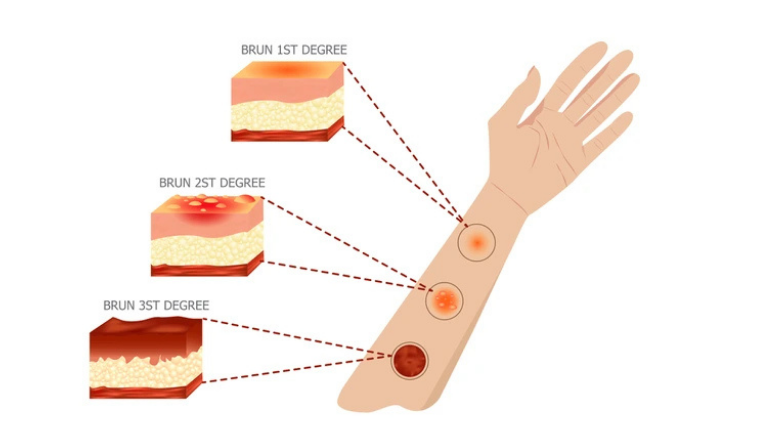 Burns Scar Surgery in Mumbai by Dr. Vinay Jacob at the Reconstructive Surgeons