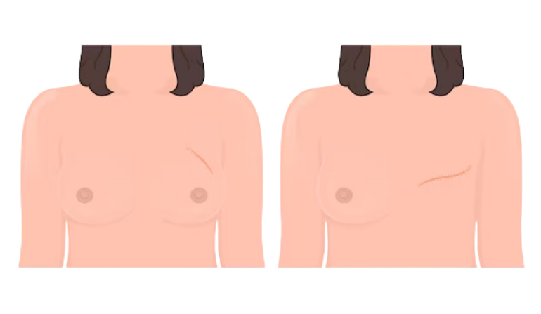 Cancer Reconstruction Surgery  in Mumbai by Dr. Vinay Jacob at the Reconstructive Surgeons