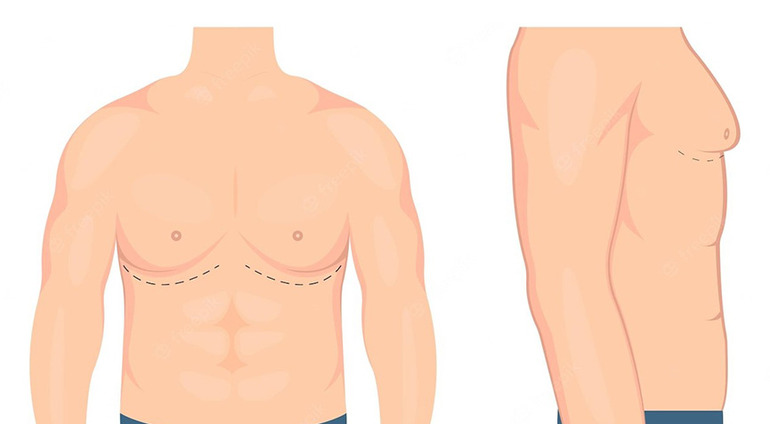 Gynecomastia Surgery in Mumbai by Dr. Vinay Jacob at the Reconstructive Surgeons