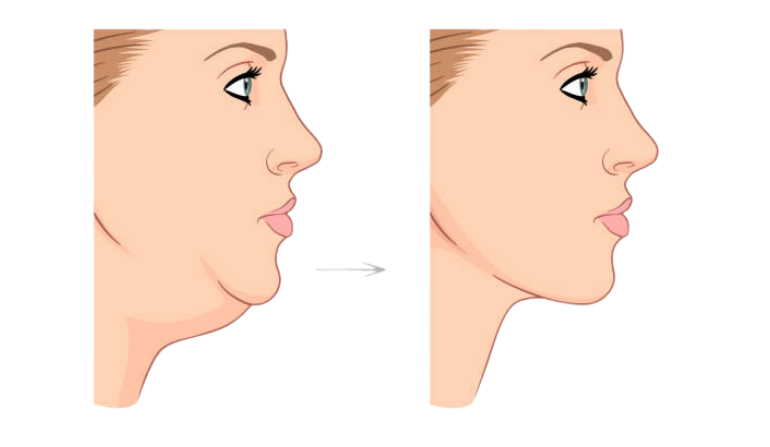Jaw Reconstruction Surgery in Mumbai by Dr. Vinay Jacob at the Reconstructive Surgeons