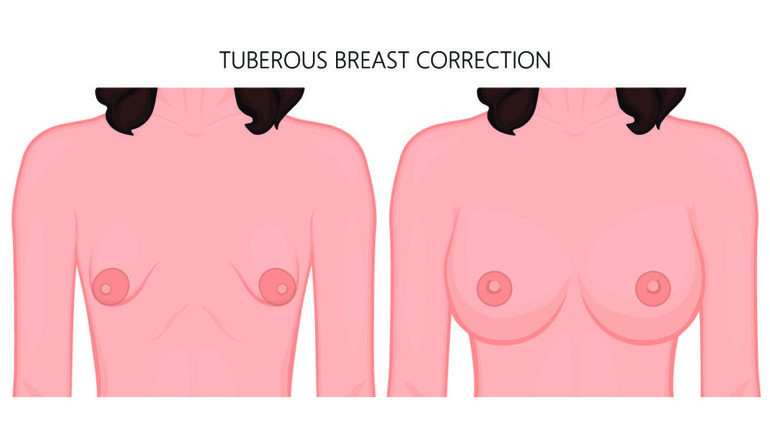 Tuberous Breast Correction Surgery in Mumbai by Dr. Vinay Jacob at the Reconstructive Surgeons