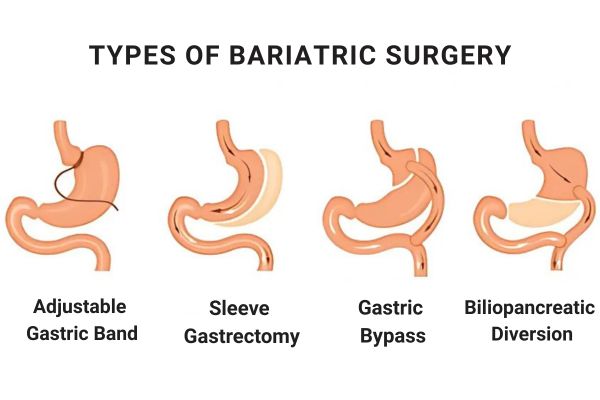 Types of Bariatric Surgery in Mumbai by Dr. Vinay Jacob at the Reconstructive Surgeons