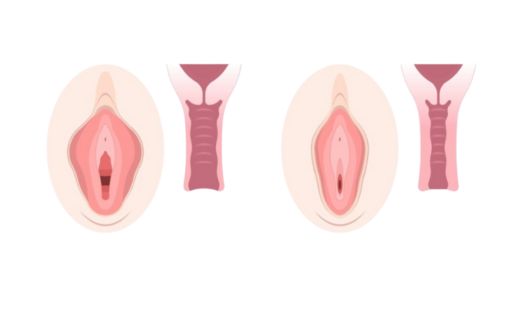 Vaginal Tightening Surgery in Mumbai by Dr. Vinay Jacob at the Reconstructive Surgeons