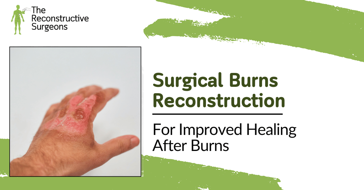Surgical Reconstruction for Burns in Mumbai by Dr. Vinay Jacob