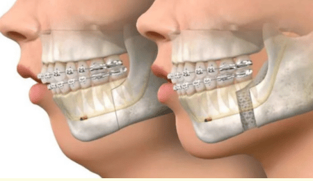 Treatment and Recovery of Jaw Reconstruction