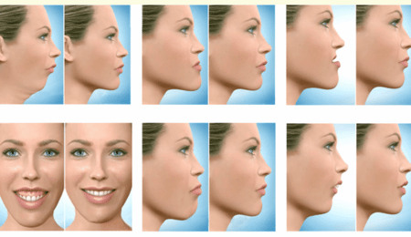 Why People Need Jaw Reconstruction